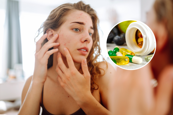 Scientists Reveal Common Supplement That Reduces Acne