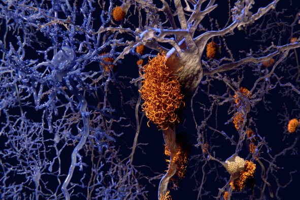 Alzheimer's Worsened by Toxic Release From Brain's Own Support Cells