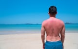 ‘I fell asleep on the beach in the sun. The next day I couldn’t walk’ – the melanoma epidemic in older men