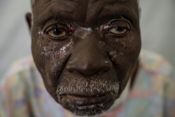 A photographer captures the mpox health crisis in Africa in a closeup