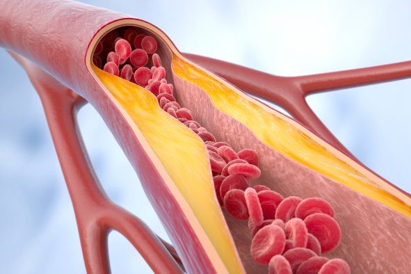 Heart Health: Cholesterol Risk Begins 'Much Earlier' Than Thought