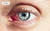 Five common eye infections and how to treat them