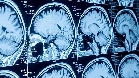 A cheap antidepressant could help treat incurable brain tumours, early studies show