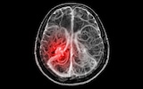 The six symptoms and warning signs of a stroke